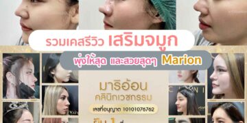รีวิวเสริมจมูกมาริอ้อน