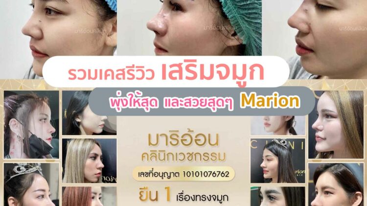 รีวิวเสริมจมูกมาริอ้อน